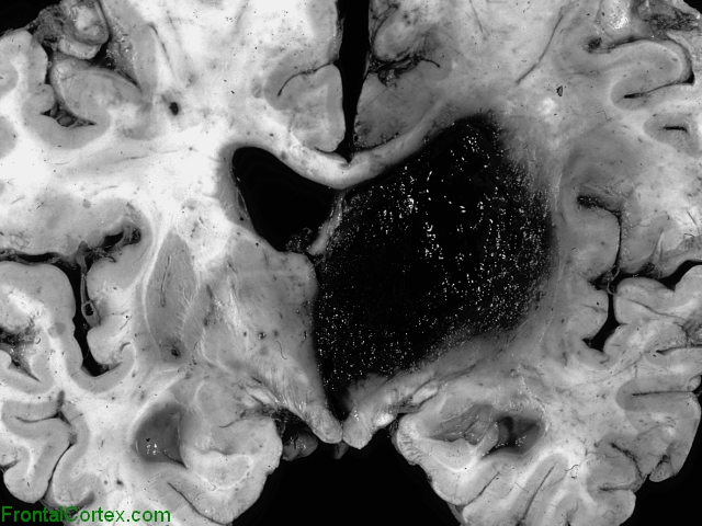 Thalamic Hemorrhage, Coronal section of brain